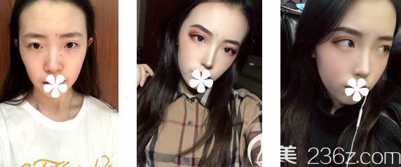 福州名韓孫主任全肋骨隆鼻術(shù)后三個月前后對比效果