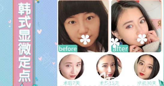 孫振東韓式顯微定點雙眼皮一年后恢復(fù)照