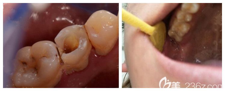 青島維樂(lè)口腔田珊珊磨牙根管治療案例 青島維樂(lè)口腔田珊珊磨牙根管治療案例