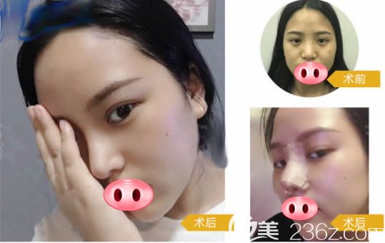 福州名韓察鵬飛鼻綜合1-7拆線及一個月恢復(fù)照 福州名韓察鵬飛鼻綜合1-7拆線及一個月恢復(fù)照