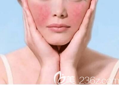 激光去紅血絲多少錢？激光去紅血絲的原理