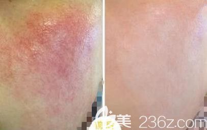 激光去紅血絲效果好不好真人前后效果對比