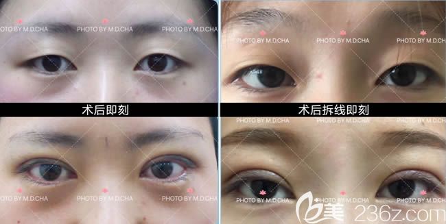 察鵬飛韓國雙眼皮術(shù)后即刻效果對比照和術(shù)后7天拆線對比效果 察鵬飛韓國雙眼皮術(shù)后即刻效果對比照和術(shù)后7天拆線對比效果