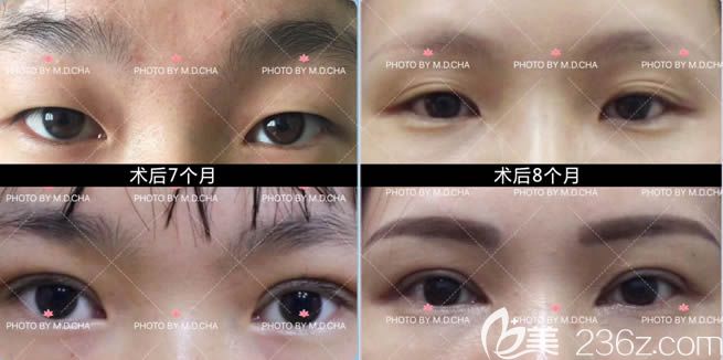 察醫(yī)生全切雙眼皮+開眼角術(shù)后7個月和術(shù)后8個月對比效果圖 察醫(yī)生全切雙眼皮+開眼角術(shù)后7個月和術(shù)后8個月對比效果圖