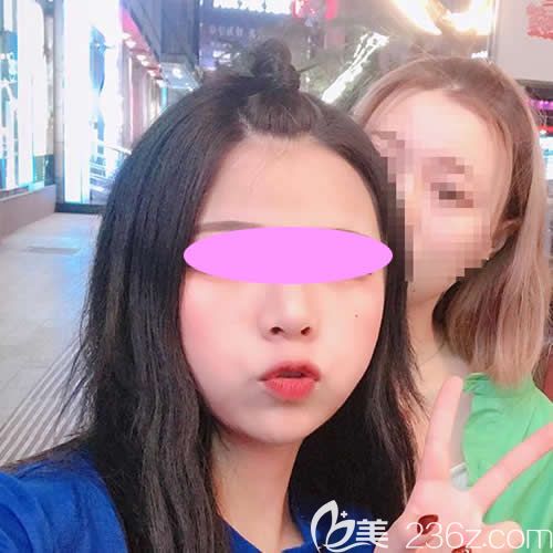 我找西寧時(shí)光祁永章做假體+自體肋骨鼻綜合術(shù)后第36天<span style=