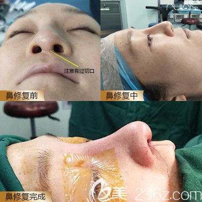 深圳潤澤瑞尼絲陳敬武隆鼻失敗修復(fù)案例