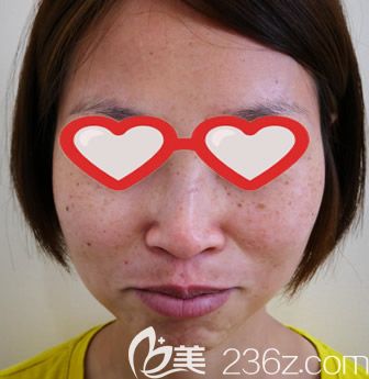 呼和浩特大韓整形皮秒激光祛斑前 呼和浩特大韓整形皮秒激光祛斑前