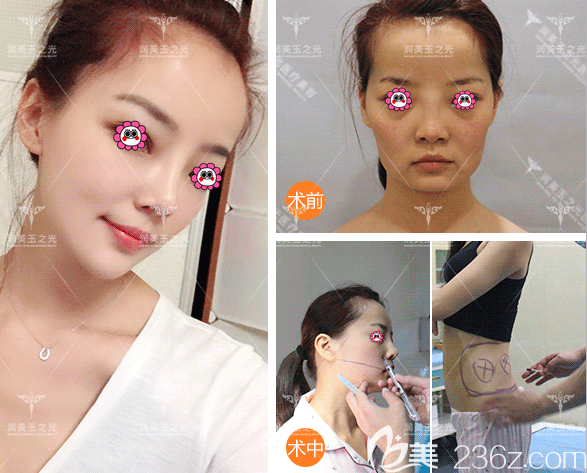 北京潤(rùn)美玉之光王明利面部自體脂肪填充案例 北京潤(rùn)美玉之光王明利面部自體脂肪填充案例