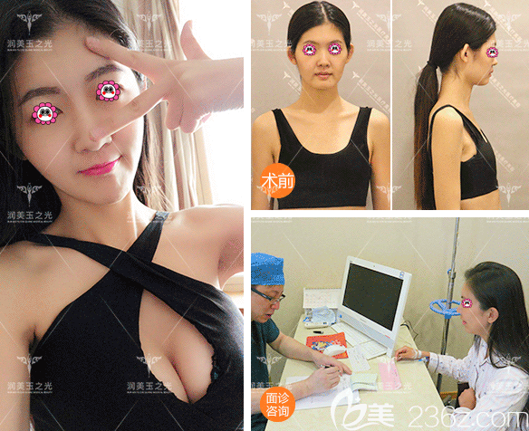 北京潤(rùn)美玉之光王明利醫(yī)生自體脂肪豐胸案例 北京潤(rùn)美玉之光王明利醫(yī)生自體脂肪豐胸案例