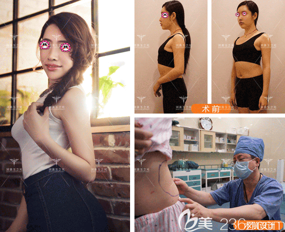 北京潤(rùn)美玉之光王明利醫(yī)生自體脂肪豐臀案例 北京潤(rùn)美玉之光王明利醫(yī)生自體脂肪豐臀案例