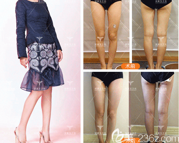 北京潤(rùn)美玉之光王明利醫(yī)生腿部吸脂案例 北京潤(rùn)美玉之光王明利醫(yī)生腿部吸脂案例