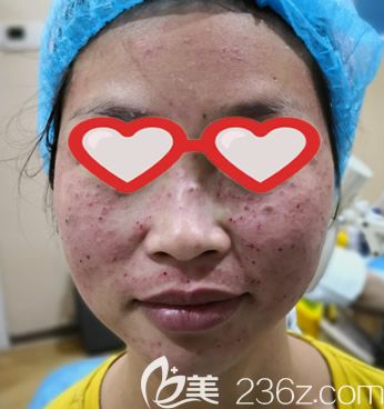 找呼市大韓整形陳琳醫(yī)生激光祛斑即刻效果 找呼市大韓整形陳琳醫(yī)生激光祛斑即刻效果