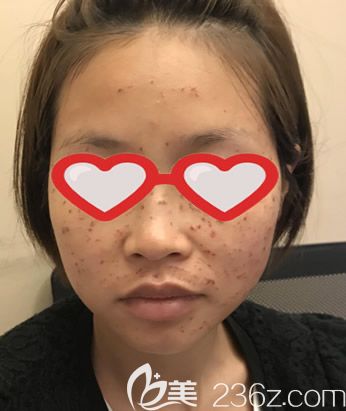 激光祛斑第二天圖片 激光祛斑第二天圖片