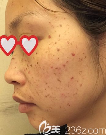 皮秒激光祛斑第三天臉有點(diǎn)癢 皮秒激光祛斑第三天臉有點(diǎn)癢