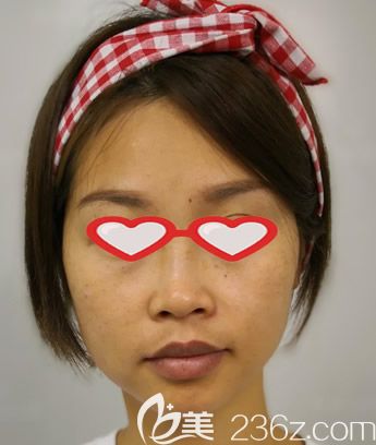 皮秒祛斑10天變化圖片 皮秒祛斑10天變化圖片