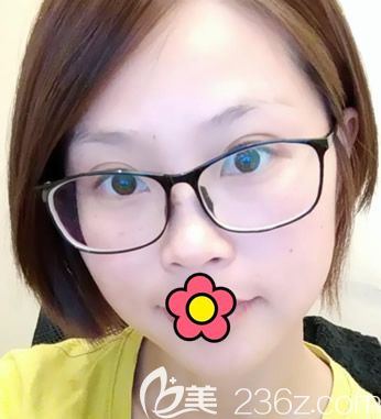 呼和浩特大韓整形咋樣 看陳琳院長(zhǎng)皮秒祛斑案例（網(wǎng)友說激光祛斑后悔死了在我身上不存在）