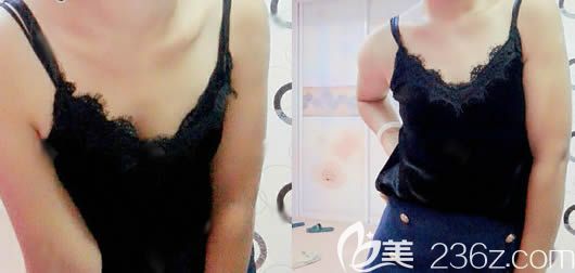 我在長春中妍做隆胸前的照片 我在長春中妍做隆胸前的照片