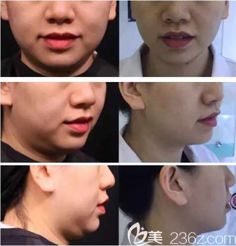 重慶軍美整形去雙下巴案例