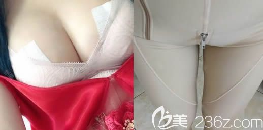 在長春中妍整形做隆胸和吸脂術(shù)后一周 在長春中妍整形做隆胸和吸脂術(shù)后一周