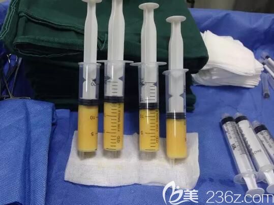 抽取大腿內(nèi)側(cè)脂肪來做填充面部