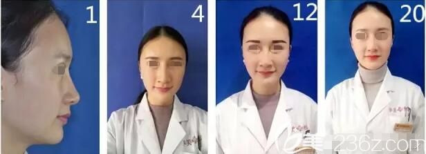 經(jīng)過專業(yè)的檢驗和血壓測量一切合格后 淮安華美高主任用自身大腿內(nèi)側(cè)的脂肪來做移植填充體驗日記公開