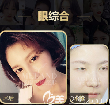 濟(jì)南美蓮眼綜合案例一