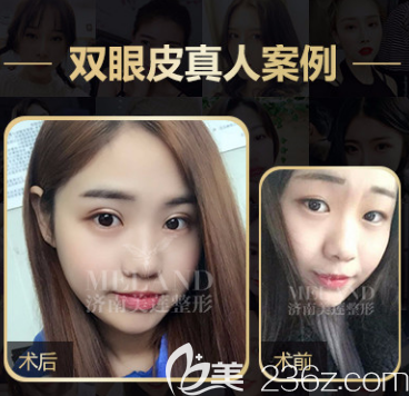 濟(jì)南美蓮眼綜合案例二