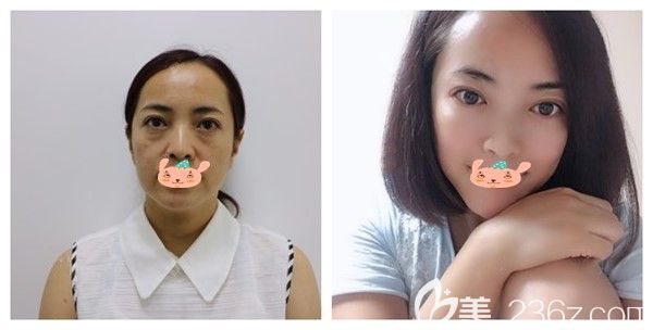 孝感天妃醫(yī)美整形醫(yī)院何琦蕾面部埋線提升前后對比案例展示 孝感天妃醫(yī)美整形醫(yī)院何琦蕾面部埋線提升前后對比案例展示