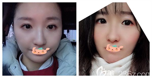 孝感天妃整形醫(yī)院何琦蕾醫(yī)生瘦臉術后案例效果對比圖 孝感天妃整形醫(yī)院何琦蕾醫(yī)生瘦臉術后案例效果對比圖