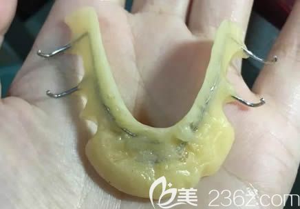 正畸中的平導圖片 正畸中的平導圖片