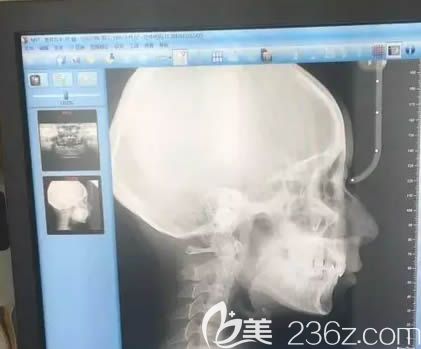 在長沙利爾口腔做矯正前排的ct片子 在長沙利爾口腔做矯正前排的ct片子