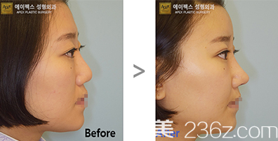 韓國愛佩思鼻綜合隆鼻案例效果前后對比