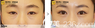 韓國愛佩思眼部綜合整形案例效果對比圖