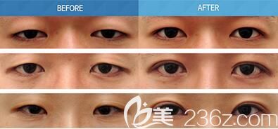 上瞼下垂矯正手術(shù)案例 上瞼下垂矯正手術(shù)案例