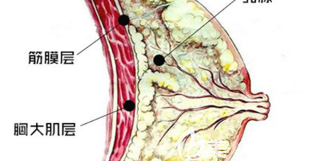 假體隆胸示意圖