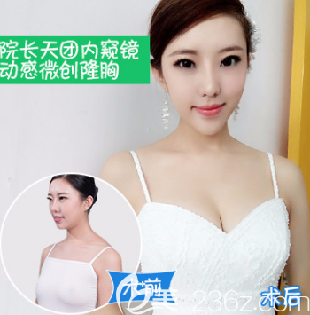 假體隆胸案例二