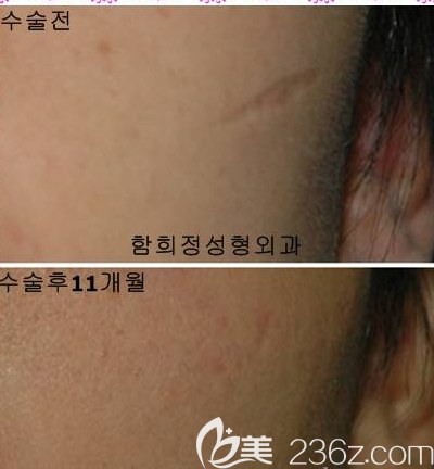 韓國(guó)dr.ham's疤痕醫(yī)院案例 韓國(guó)dr.ham's疤痕醫(yī)院案例