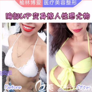 榆林博愛整形醫(yī)院假體隆胸案例一