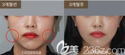 面部吸脂案例 面部吸脂案例