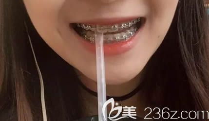 我在長沙利爾口腔做金屬托槽牙齒矯正已經(jīng)快摘牙套了,感覺深覆合戴平導(dǎo)的效果還不錯(cuò)嘛