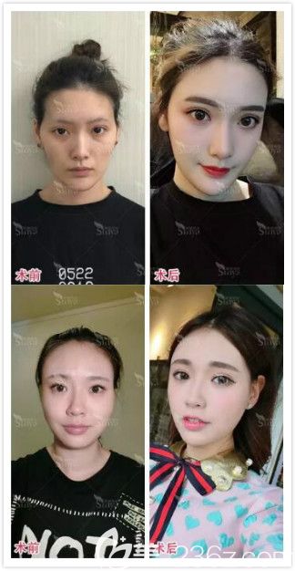長(zhǎng)沙星雅整形自體脂肪填充面部真人前后效果對(duì)比圖