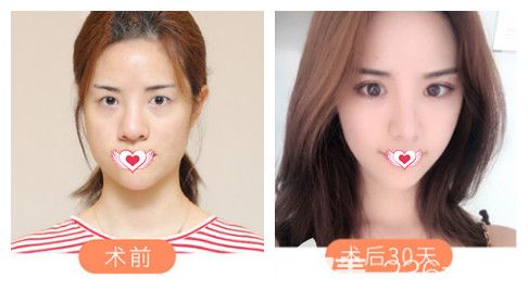 正值4月整形旺季邯鄲維多利亞推出一波優(yōu)惠活動(dòng) 580元擁有自然無痕雙眼皮