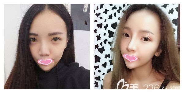 孝感天妃<!--<i data=20240703-sp></i>-->達(dá)拉斯綜合假體隆鼻手術(shù)前后對(duì)比圖片展示