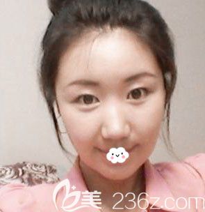 韓國(guó)自體脂肪填充效果怎么樣？真人案例術(shù)后1月效果圖