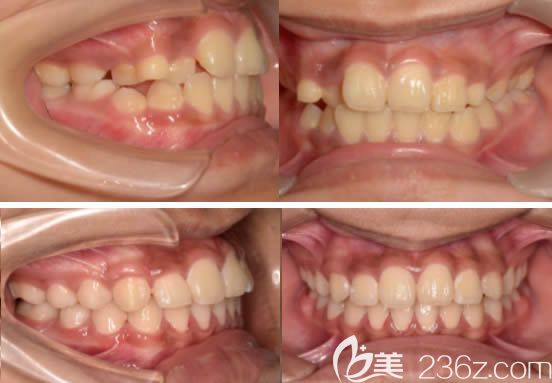 莫媛媛青少年牙齒擁擠矯正前后對(duì)比效果
