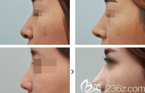 德州肋軟骨隆鼻案例