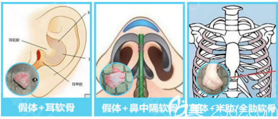 軟骨隆鼻示意圖