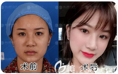 佛山曙光金子甘國端院長面部線雕提升案例