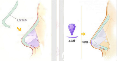 耳軟骨隆鼻示意圖