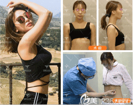 北京潤美玉之光王明利醫(yī)生JET自體脂肪豐胸案例